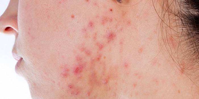 Manifestaciones de candidiasis en la piel de la cara.