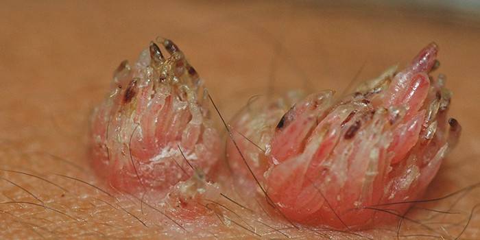 Condilomas no corpo humano