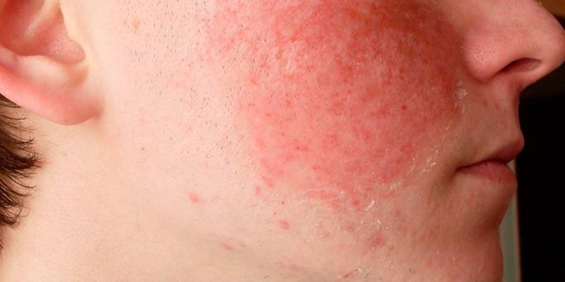 Lícová alergia