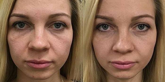 Fotos antes e depois da técnica