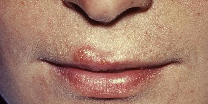 Herpes