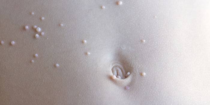 Erupciones en la piel del abdomen.
