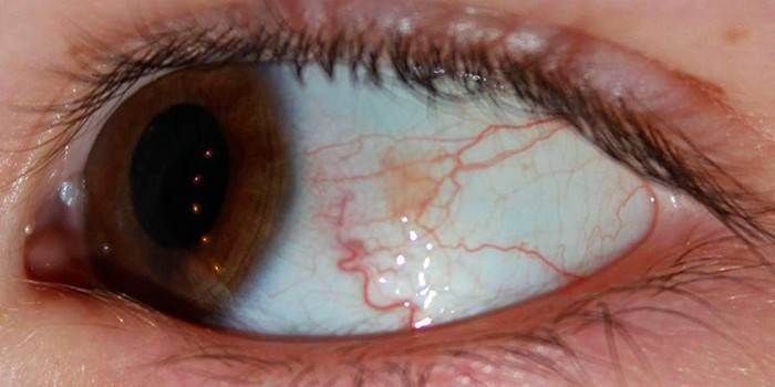 Enrojecimiento de los vasos sanguíneos del ojo.
