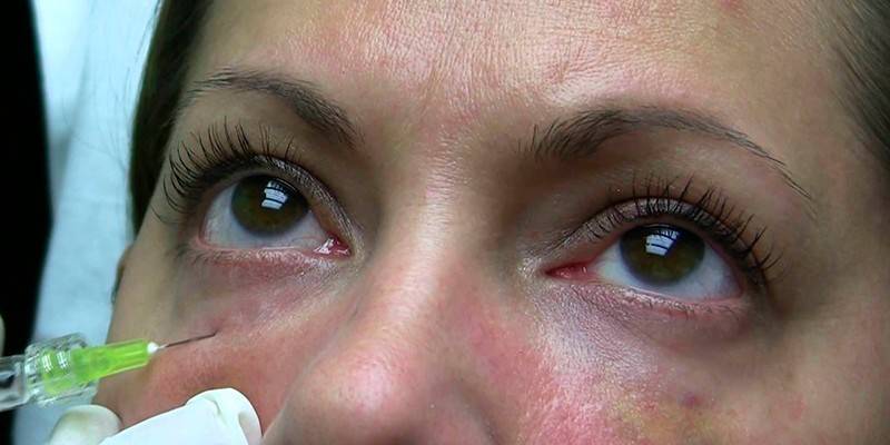 La mujer recibe una inyección debajo de los ojos