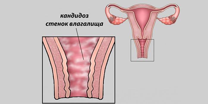 Κολπική καντιντίαση