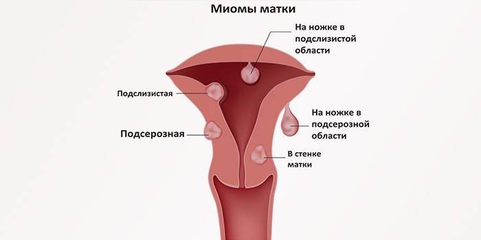Tipos de miomas uterinos