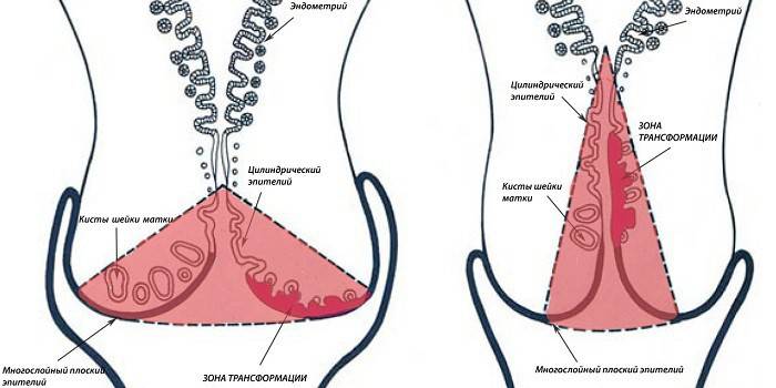 Esquema de conizacion cervical