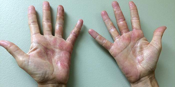 Dermatitis de contacto