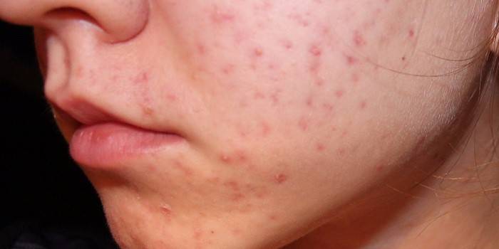 Manchas vermelhas no rosto com acne