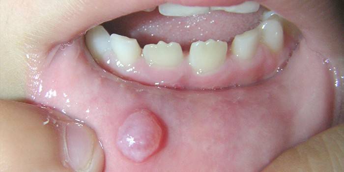 Estomatitis herpética