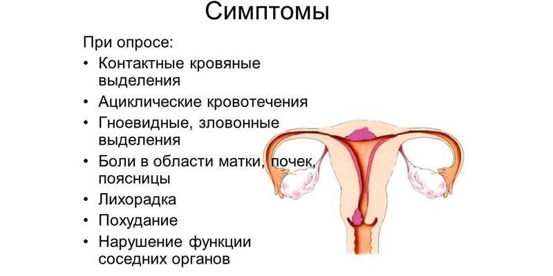 Objawy adenomiozy na schemacie