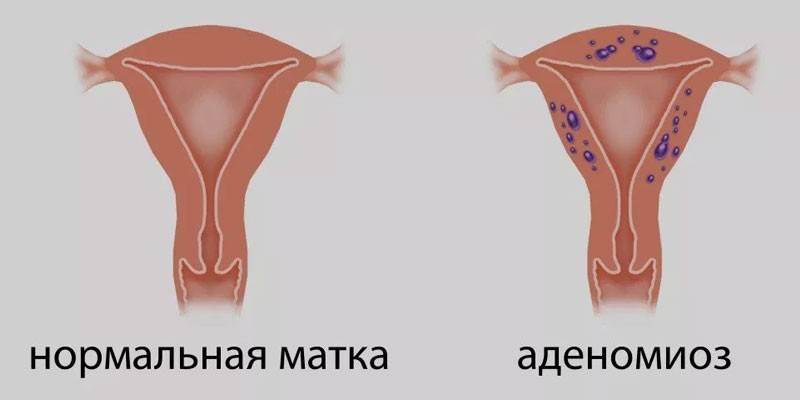 Macica na chorobę