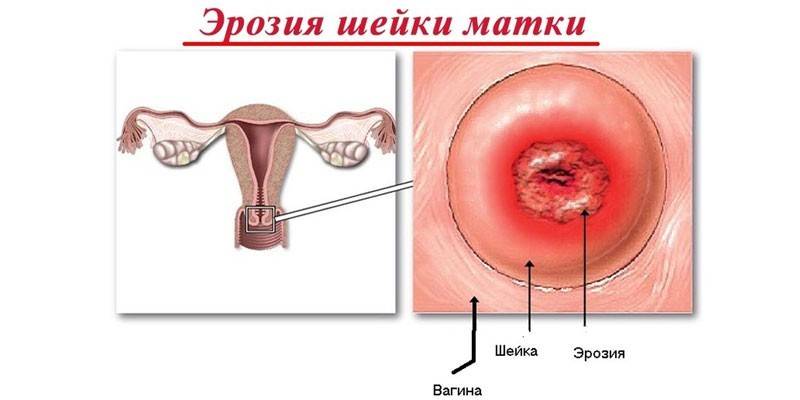 Erosión cervical