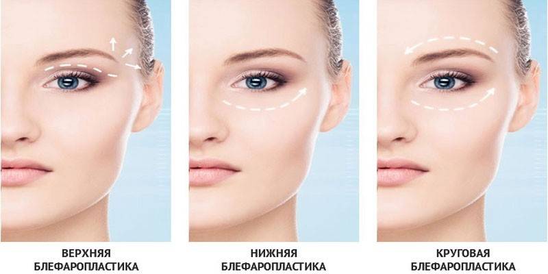 Τύποι βλεφαροπλαστικής
