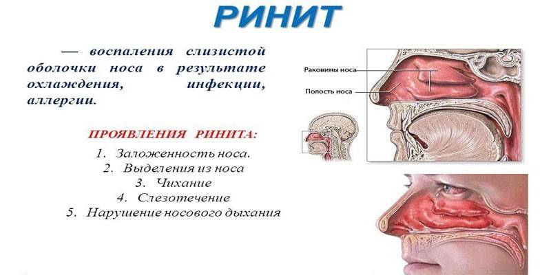 Αλλεργική ρινίτιδα