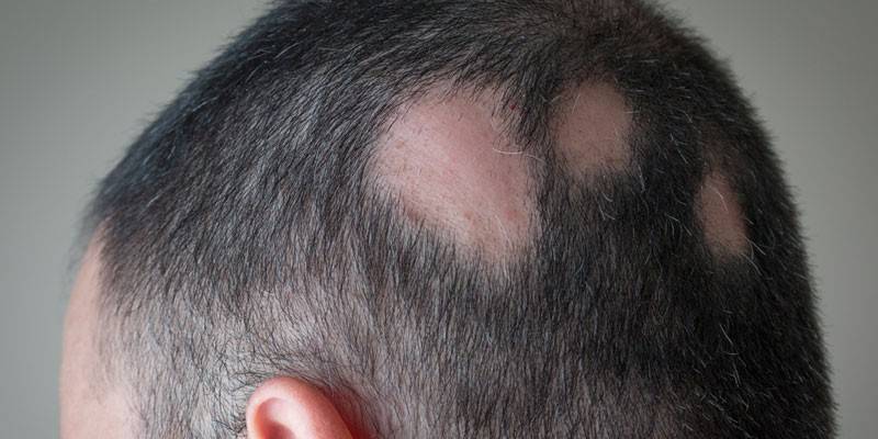 Alopecia areata
