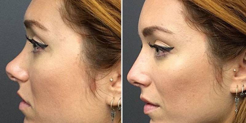 Burun estetiği öncesi ve sonrası kız fotoğrafı
