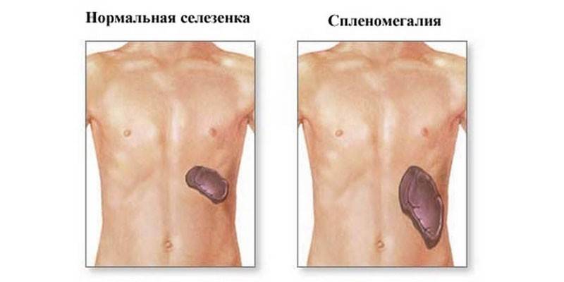 Esplenomegalia do baço