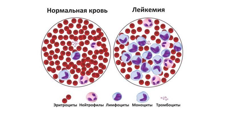 Κανονικό αίμα και λευχαιμία
