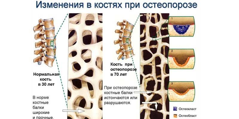 Οστικές μεταβολές στην οστεοπόρωση