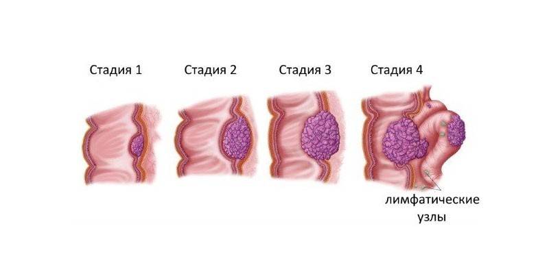 Etapas del cáncer de colon.