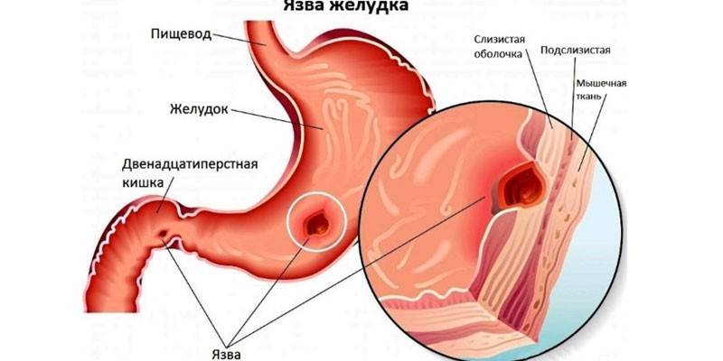 Γαστρικό και δωδεκαδακτυλικό έλκος