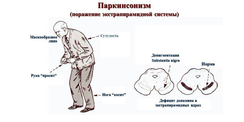 Παρκινσονισμός