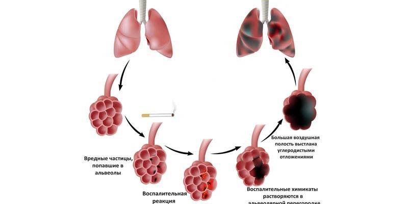 Esquema de desarrollo del enfisema pulmonar