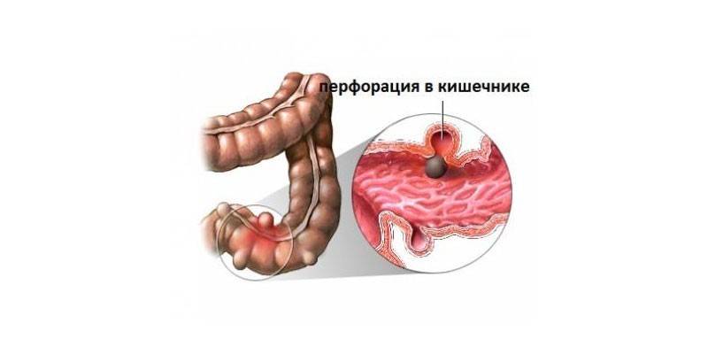 Perfuração do intestino