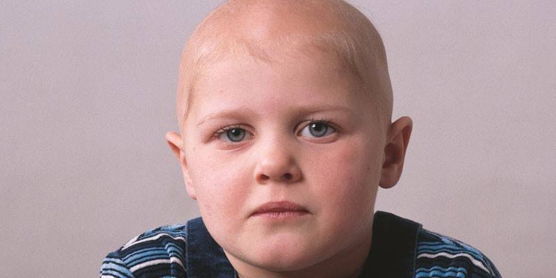 Alopecia Total em Crianças