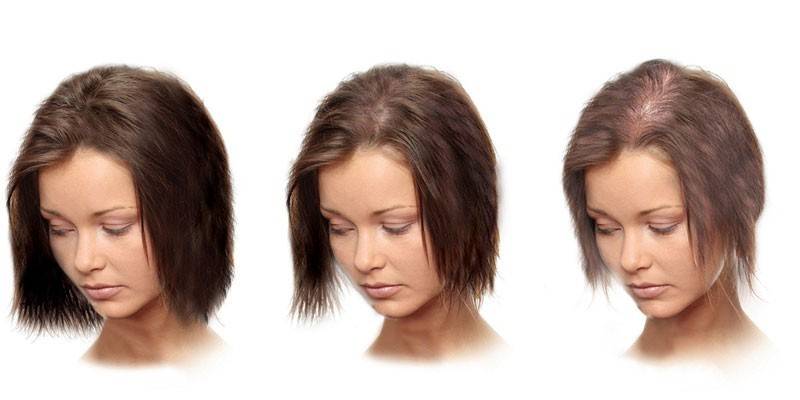 Alopecia androgenética