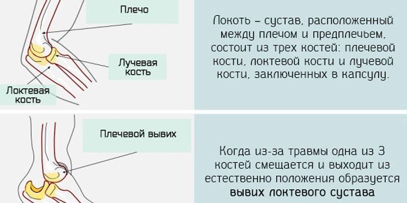 Zwichnięcie stawu łokciowego