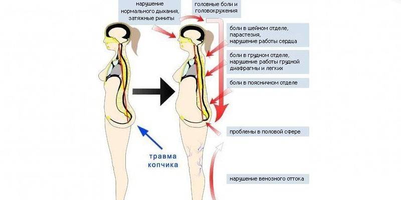 Sintomas de uma ferida de tailbone