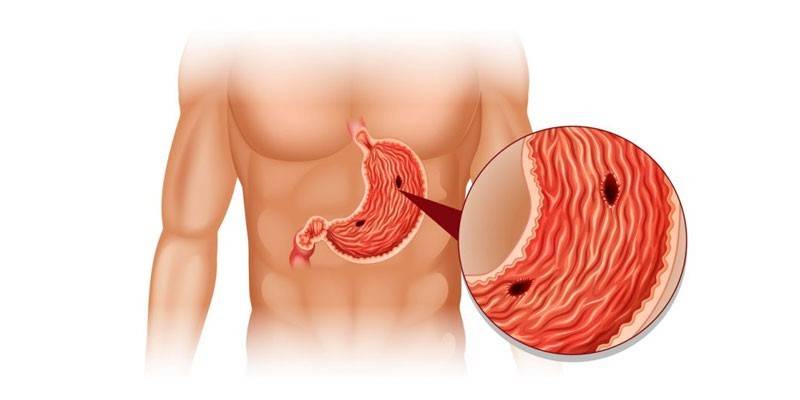 Gastroduodenitis de forma erosiva.