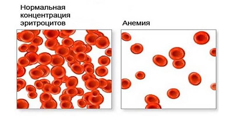 Anemia hipercrômica