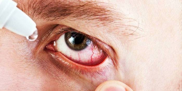 Un hombre es goteado con gotas en el ojo.