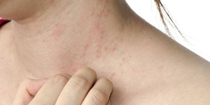 Erupções cutâneas no pescoço da mulher