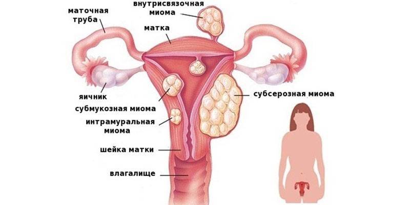 Druhy fibroidov