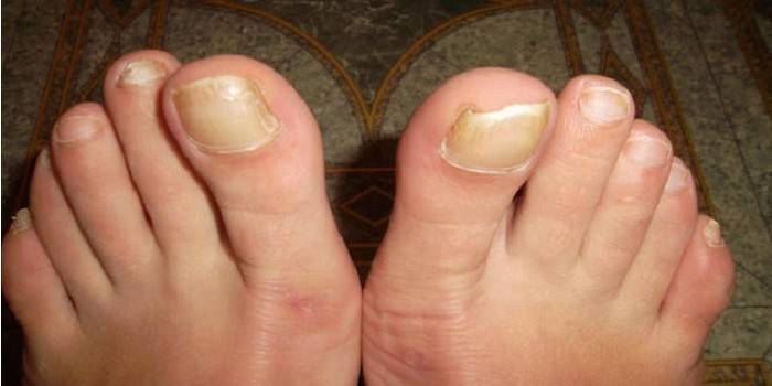 Toenails afetados