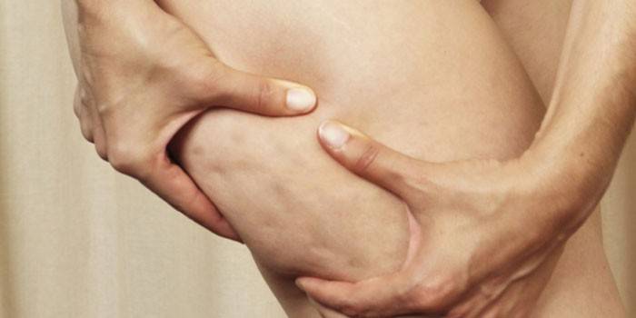 Celulitis en el cuerpo de una mujer.