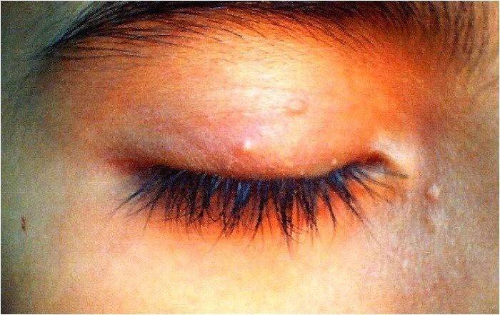 Prejav mäkkýša contagiosum