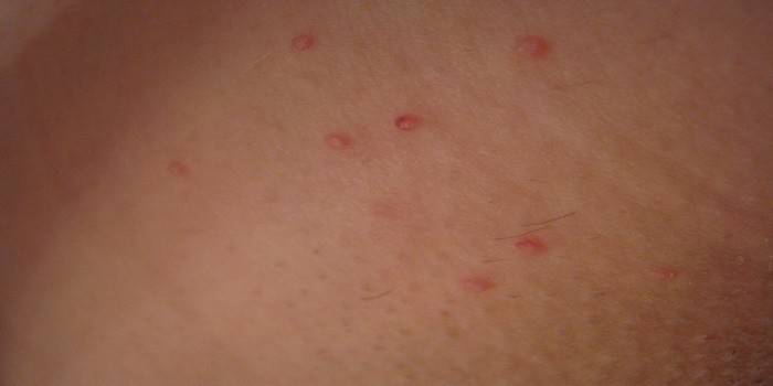 Manifestações de herpes na pele das costas