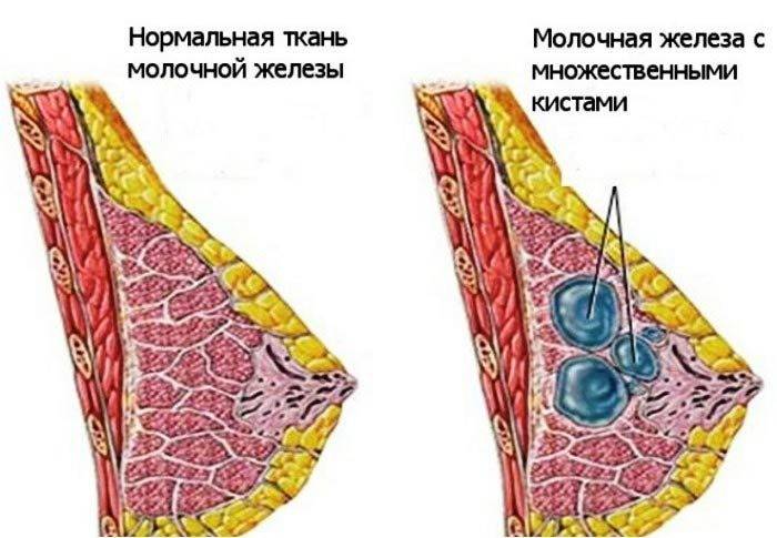 Cystická difúzna mastopatia