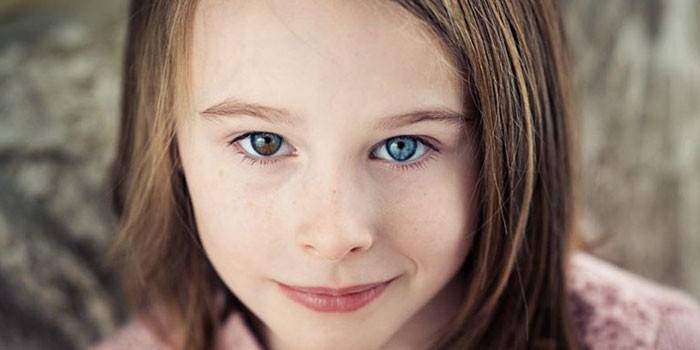 Color de ojos diferente en personas