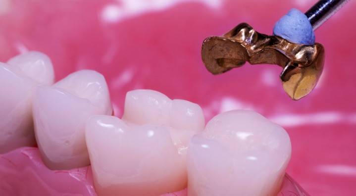 Instalação de microprostesias dentárias