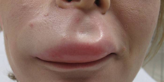 Edema de Quincke del labio superior