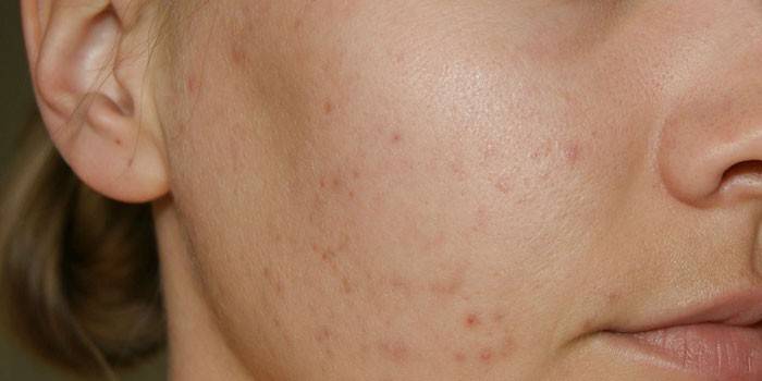 Acne no rosto