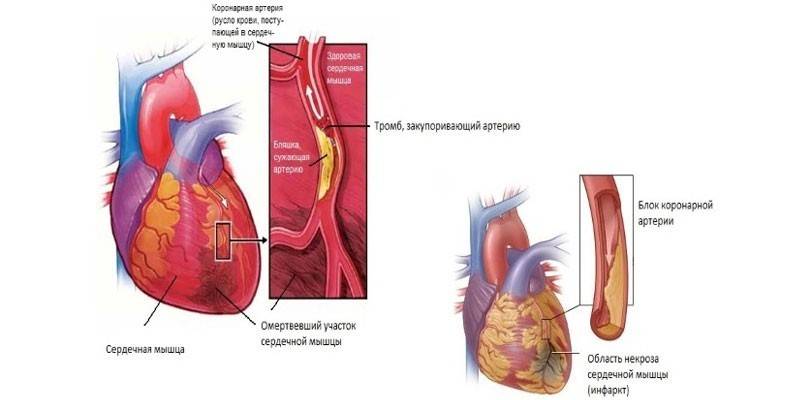 Esquema de um coágulo de sangue no coração