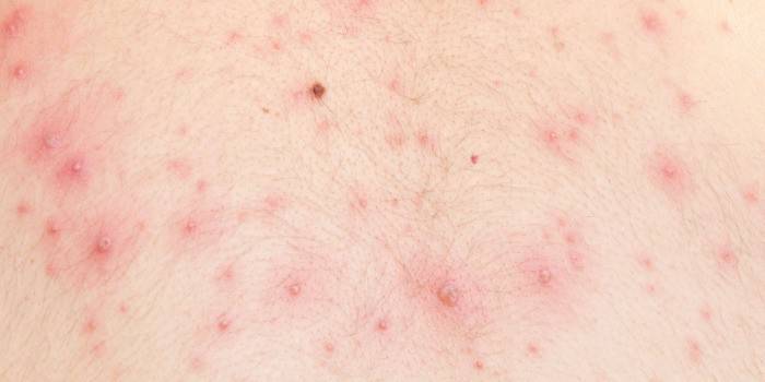 Herpes na pele humana