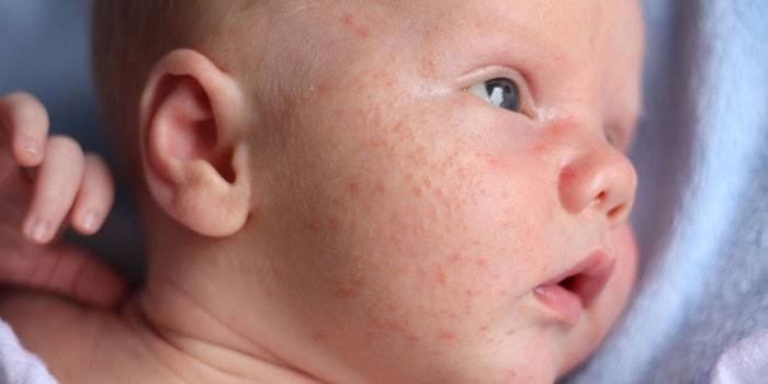 Staphylococcus em bebês